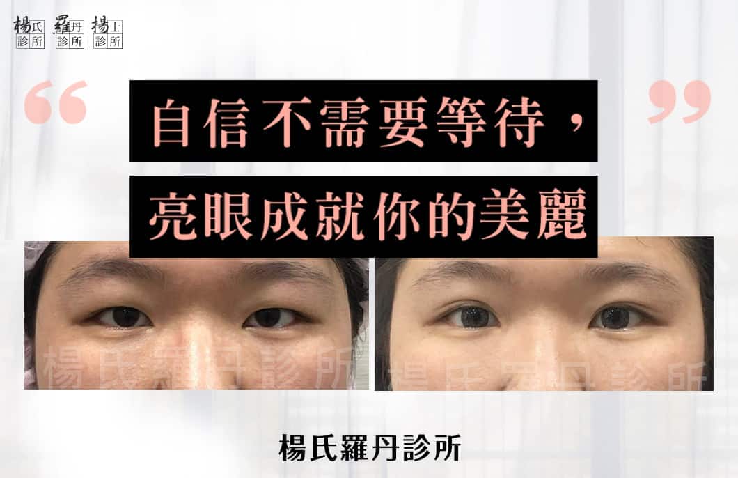 【雙眼皮】想自信別等待，亮眼成就你的美麗